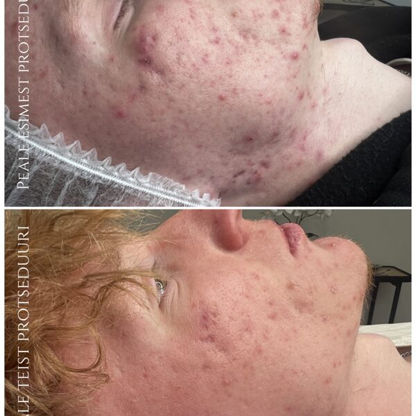 "ACNE CONTROL"  Foto: Renesmee Ilustuudio (Kosmeetik: Anna-Maria)