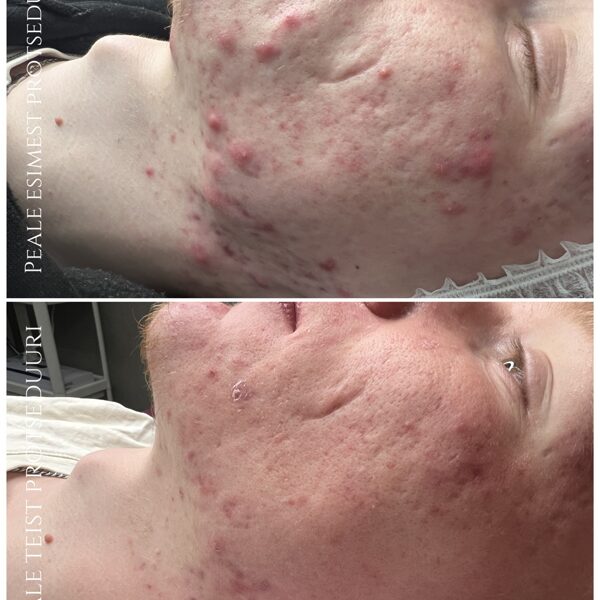 "ACNE CONTROL" Foto: Renesmee Ilustuudio (Kosmeetik: Anna-Maria)
