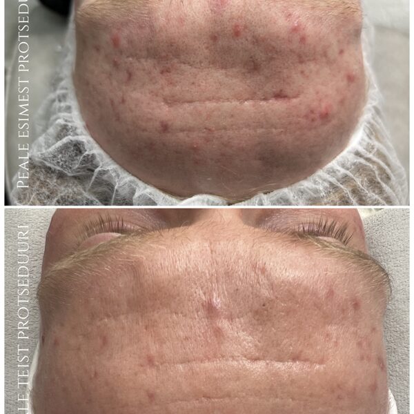 "ACNE CONTROL" Foto: Renesmee Ilustuudio (Kosmeetik: Anna-Maria)