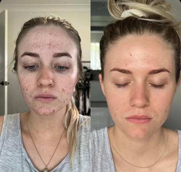 "ACNE CONTROL" - https://krx-aesthetics.eu/