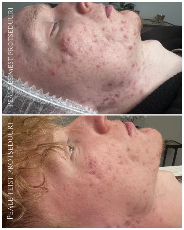 "ACNE CONTROL"  Foto: Renesmee Ilustuudio (Kosmeetik: Anna-Maria)