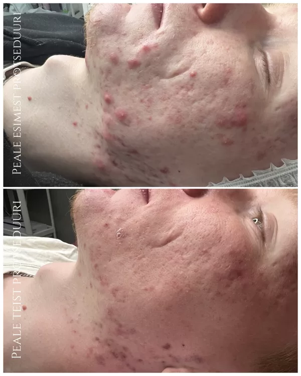 "ACNE CONTROL" Foto: Renesmee Ilustuudio (Kosmeetik: Anna-Maria)