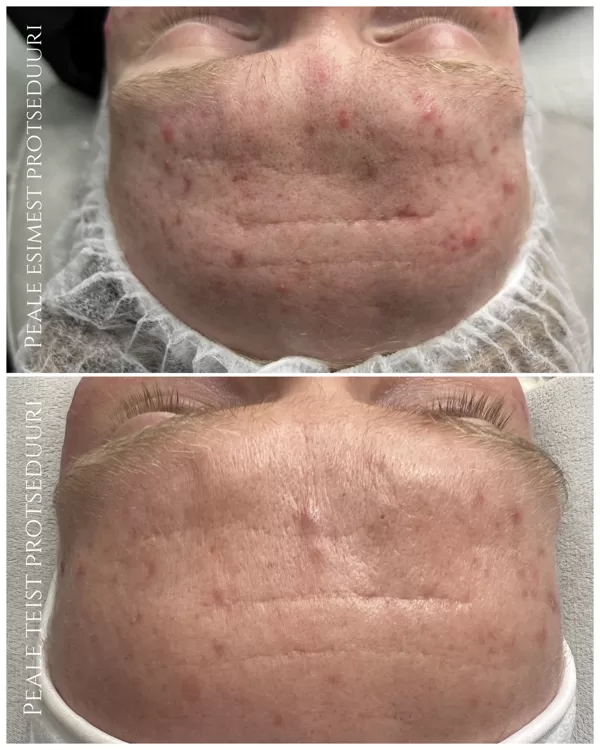 "ACNE CONTROL" Foto: Renesmee Ilustuudio (Kosmeetik: Anna-Maria)